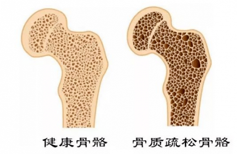 骨質疏松可防可治